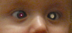 Retinoblastom hos barn.