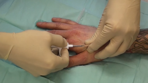 Slik så det ut da implantatet ble injisert i hånden.