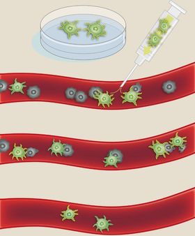 Opplæring og dyrking av immunceller i laboratorium: I laboratoriet kan immunceller få trening i å oppdage og drepe kreftceller. Spesialtrente immunceller (grønne) sprøytes inn i blodåren og går til angrep på kreftcellene (svarte). I kliniske studier har slik behandling vist seg å være effektiv mot noen typer blodkreft.