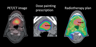Med «dose painting» er det mulig å gi ekstra mye stråling til de mest aggressive delene av en kreftsvulst.