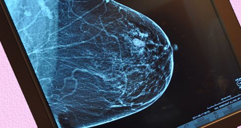 Kan radiografer tyde mammografi?