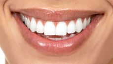 F� et hvitere smil