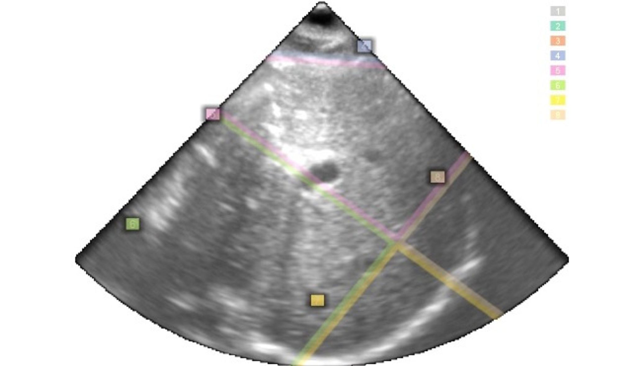 2D-ultralyd av en lever med navigasjonslinjer. 