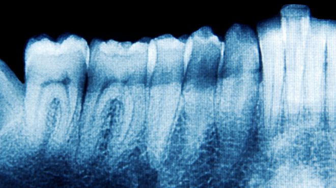 Ny studie styrker hypotesen om at tannsykdom kan utløse alzheimers