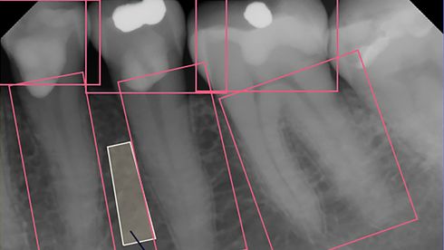 Røntgenbildene fra tannlegen kan avsløre benskjørhet
