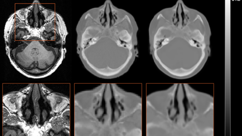Algoritme for dyp læring gjør at pasienter slipper CT-skanning og radioaktiv stråling