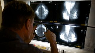 En radiolog undersøker bilder tatt ved mammografi i Los Angeles i USA.