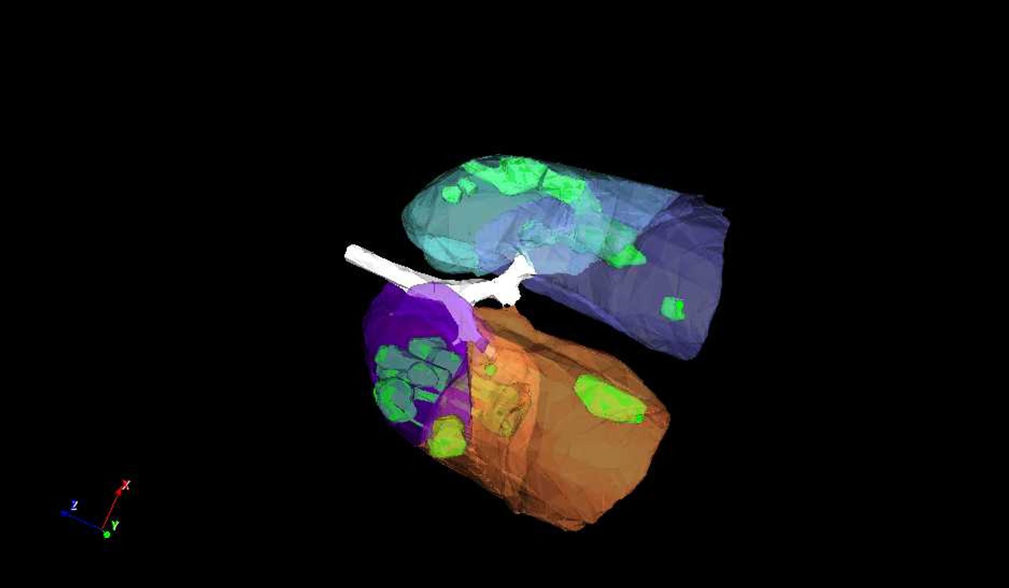 Alarm: Disse lungene er infisert av Covid-19. Det er dommen fra maskinopplært kunstig intelligens som på sekunder har analysert et CT-bilde.