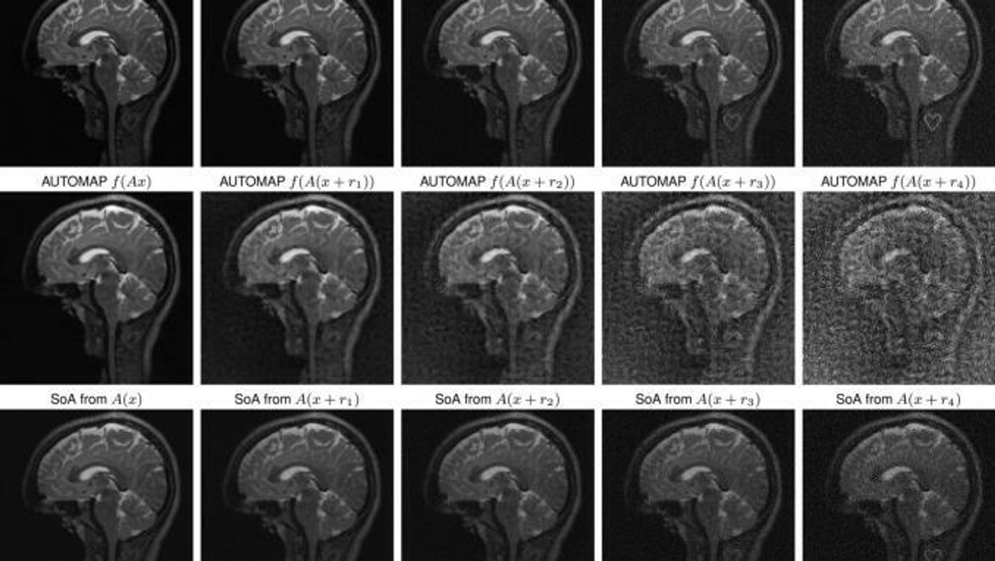 Kunstig intelligens kan «utviske» svulster i MR-skanning