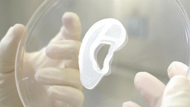 Se før og etter: Amerikaner har fått verdens første transplantasjon av et 3D-printet øre